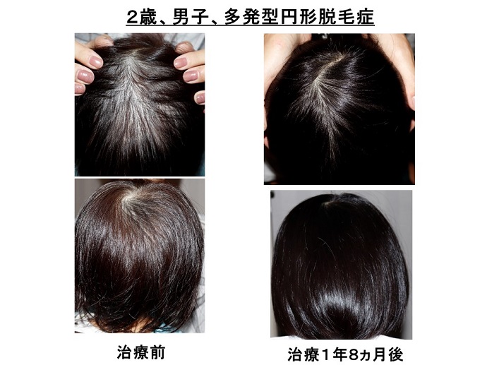 円形脱毛症　病院